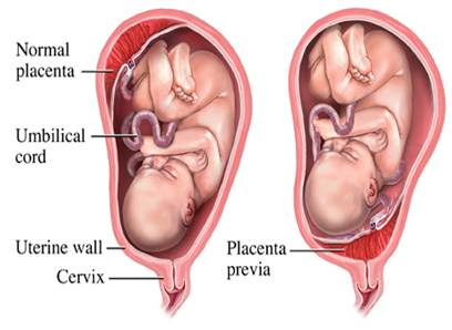 Resultado de imagen para placenta previa